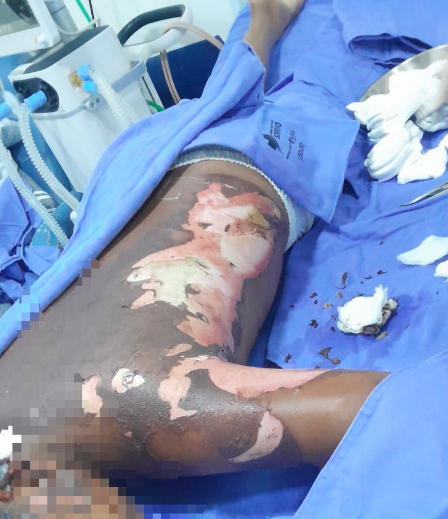 Família de adolescente queimado em Sorriso pede justiça e afirma que caso não foi acidente