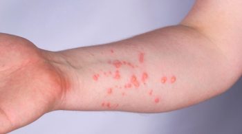 variola-monkeypox-adobe-stock-970×550 variola-monkeypox-adobe-stock-970x550